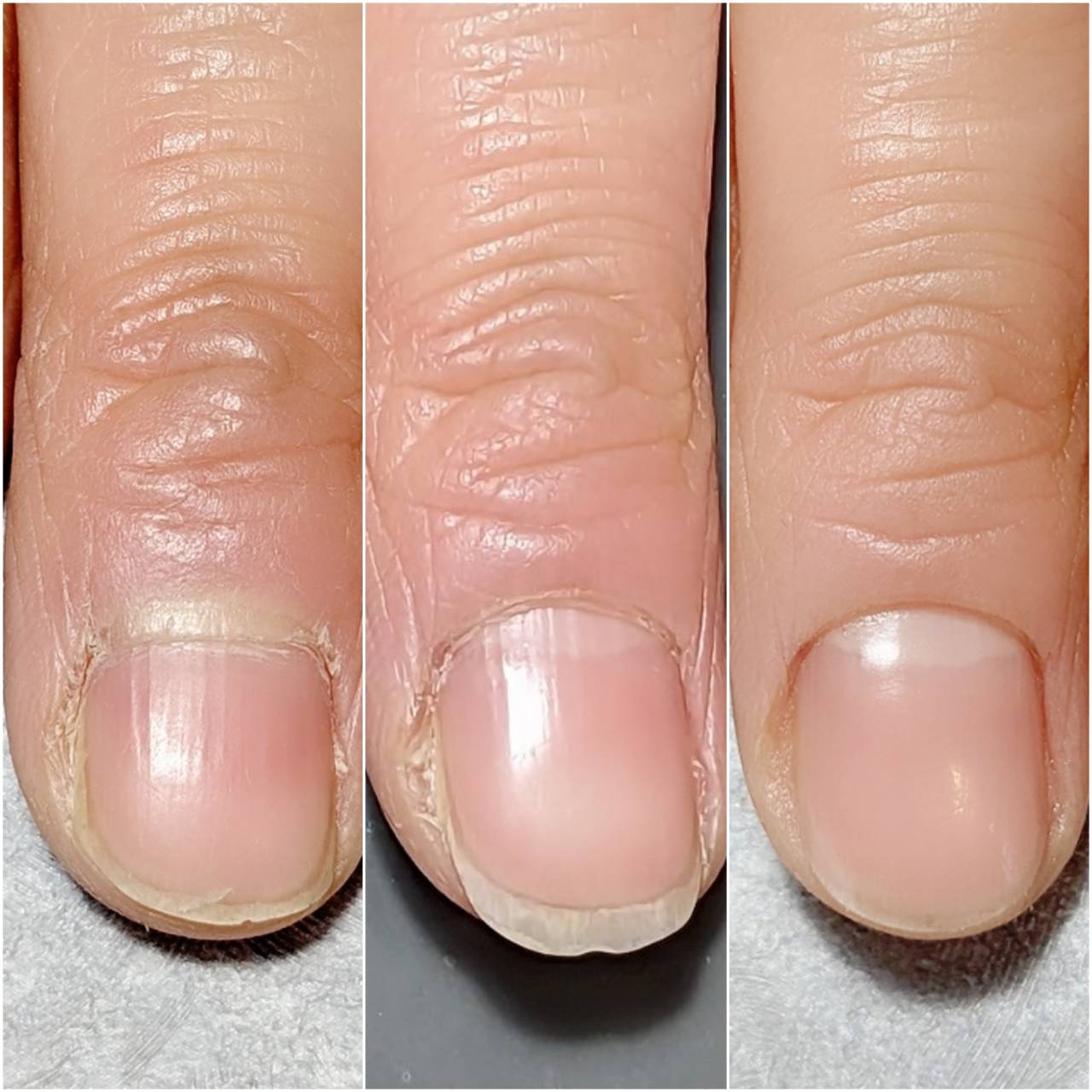 症例 Before After