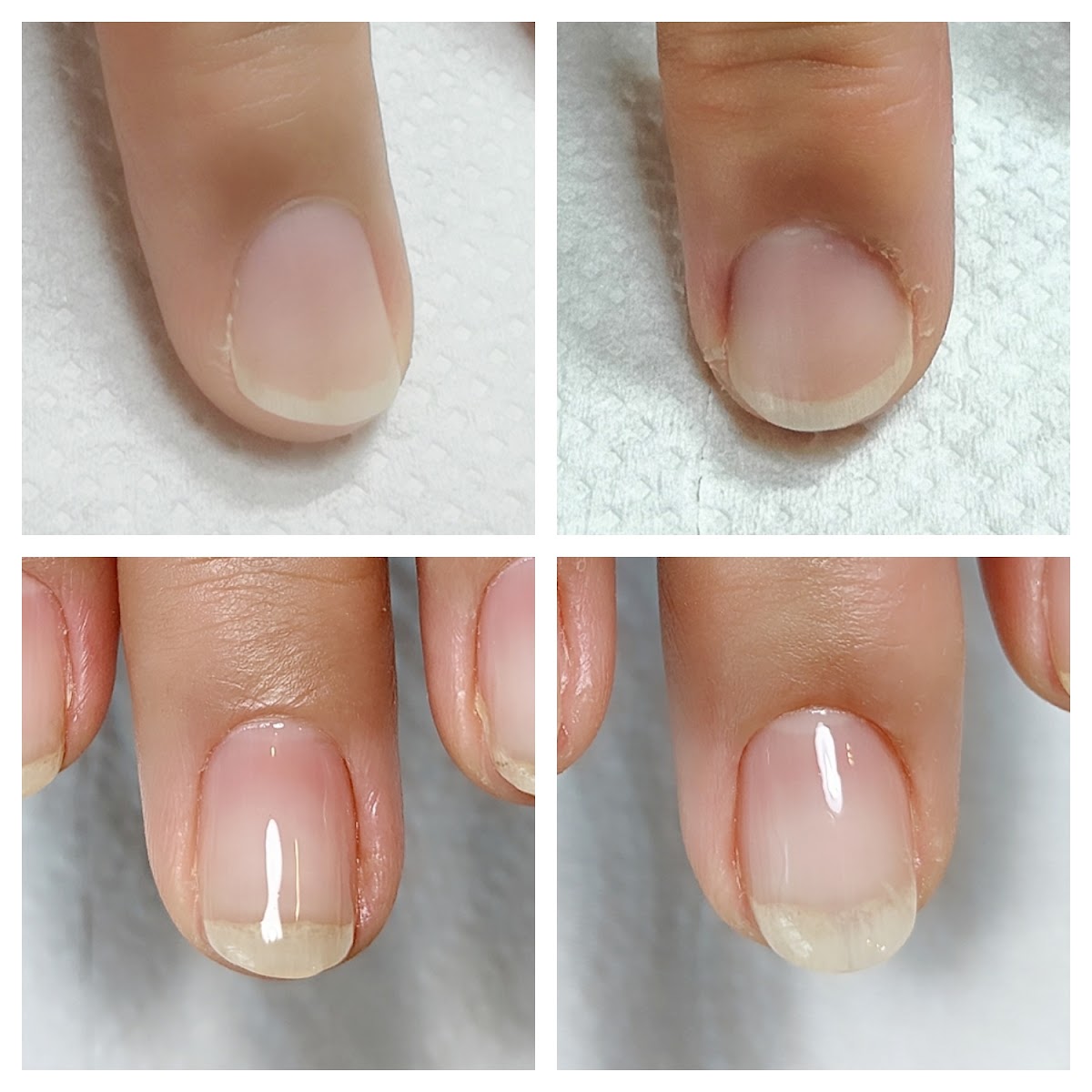症例 Before After