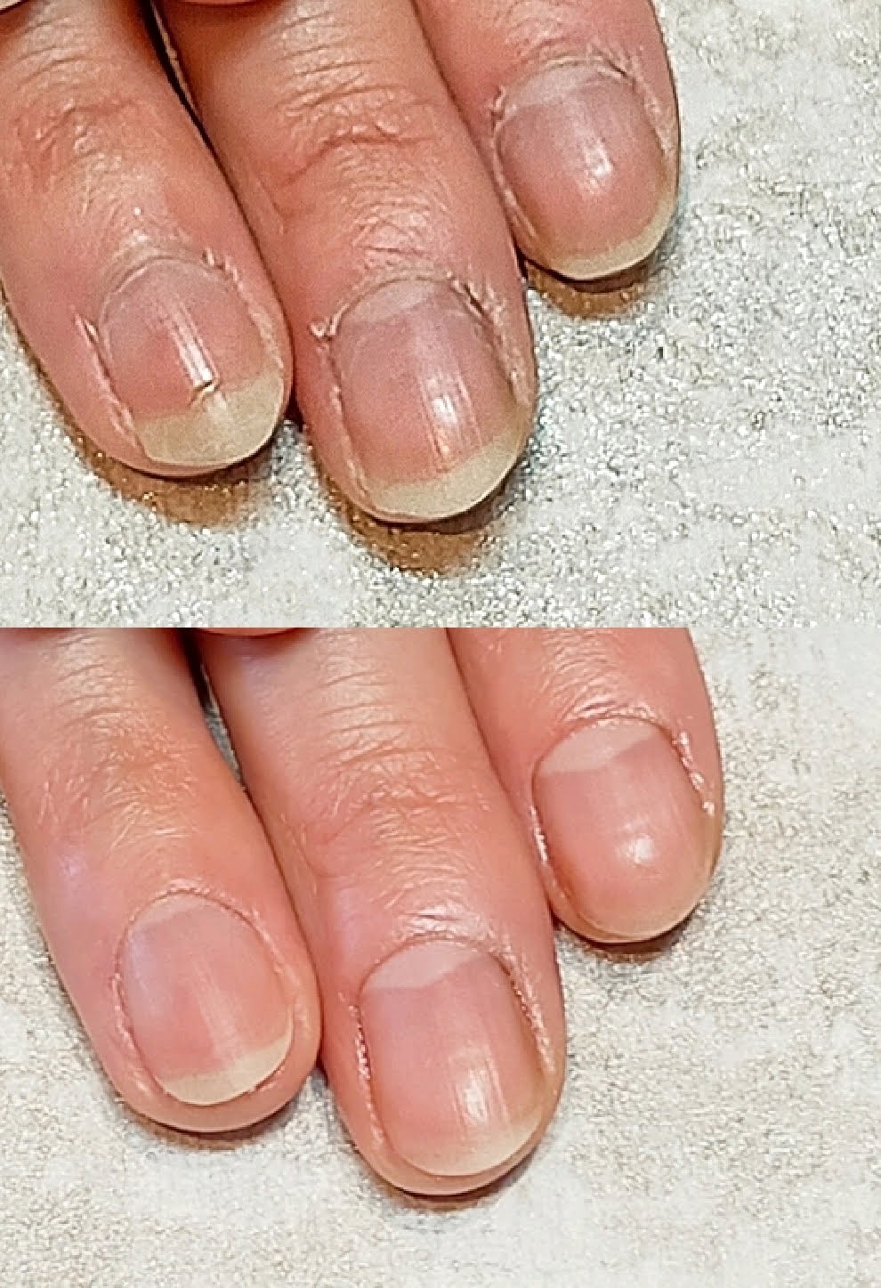 症例 Before After