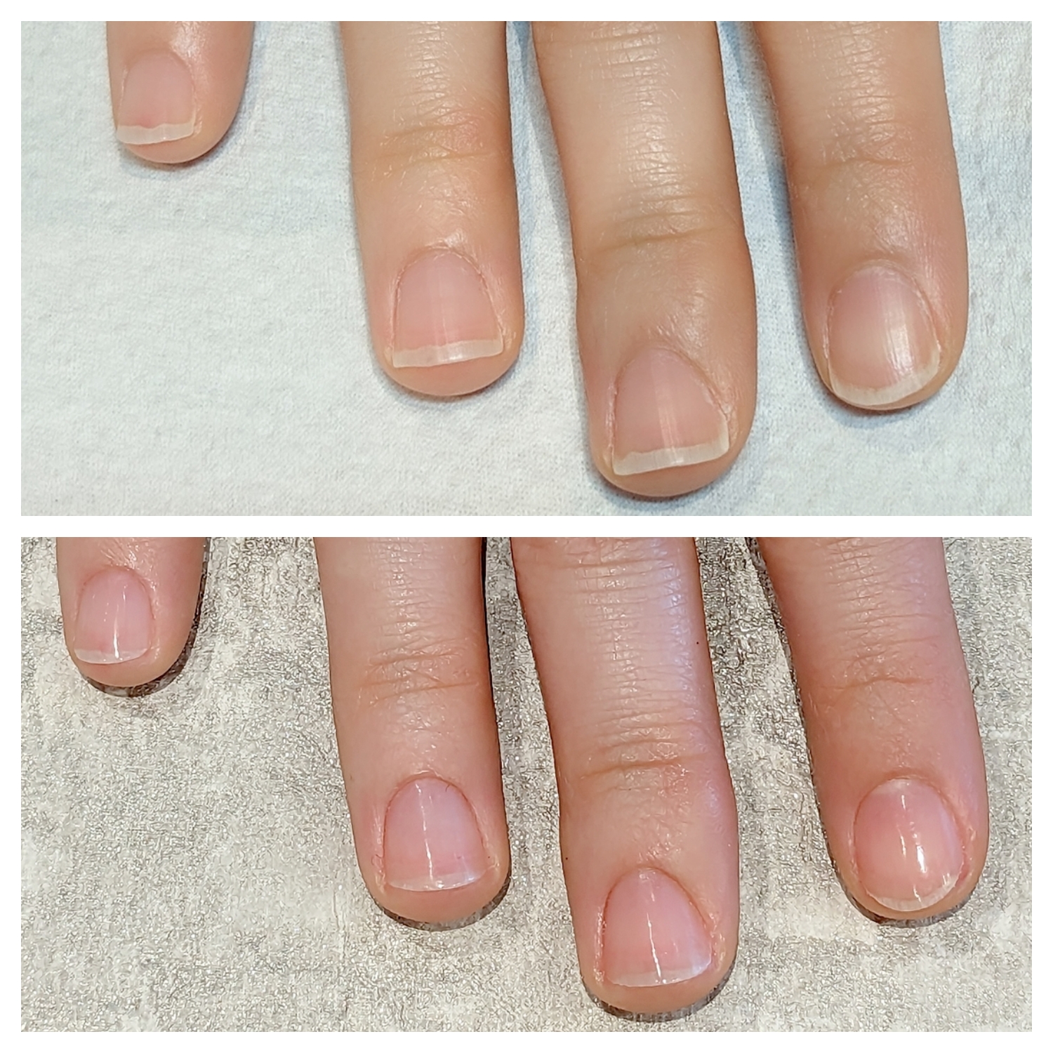 症例 Before After ネイルケア 貝爪